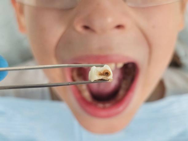 Best Emergency Wisdom Teeth Removal in Whitney, TX